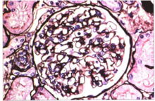 轻度系膜增生 轻度系膜增生